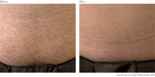 Before and After hair removal